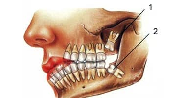 ضرس عقل مدفون